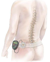 Spinal Cord Stimulator for Pain Relief - Neuroaxis